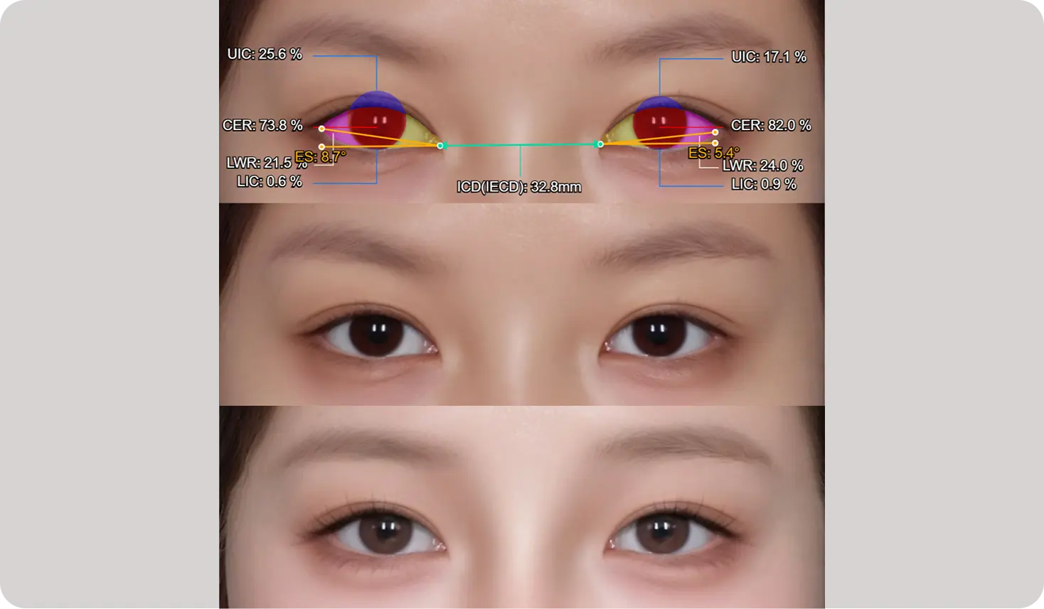 Eye Analysis